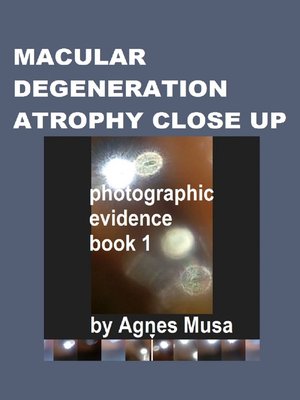 cover image of Macular Degeneration Atrophy Close Up, Photographic Evidence Book 1